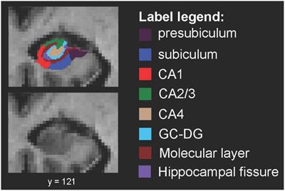 Low Subicular Volume as an Indicator of Dementia-Risk Susceptibility in Old Age